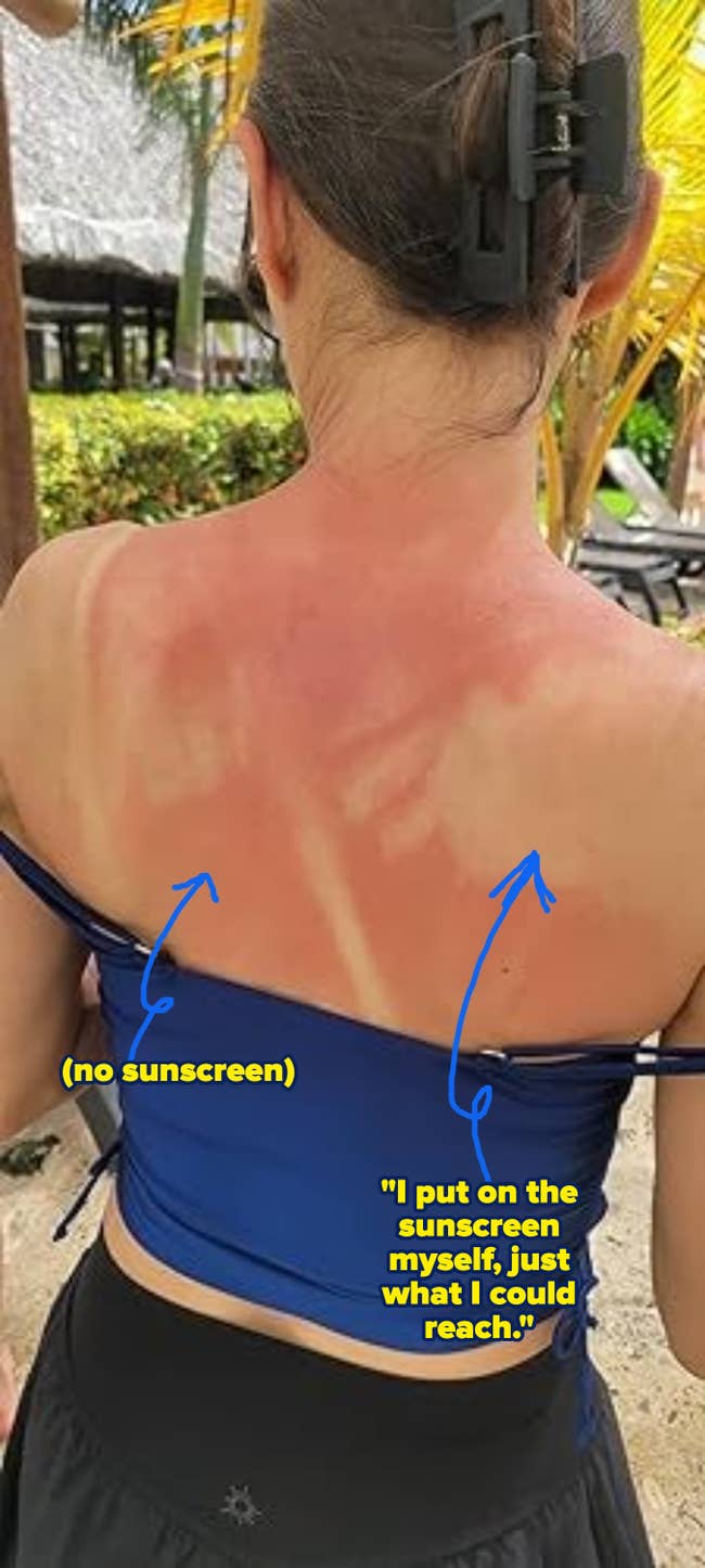 Woman outdoors with sunburned backmost showing swimsuit strap marks; wearing a bluish strapless apical and achromatic skirt