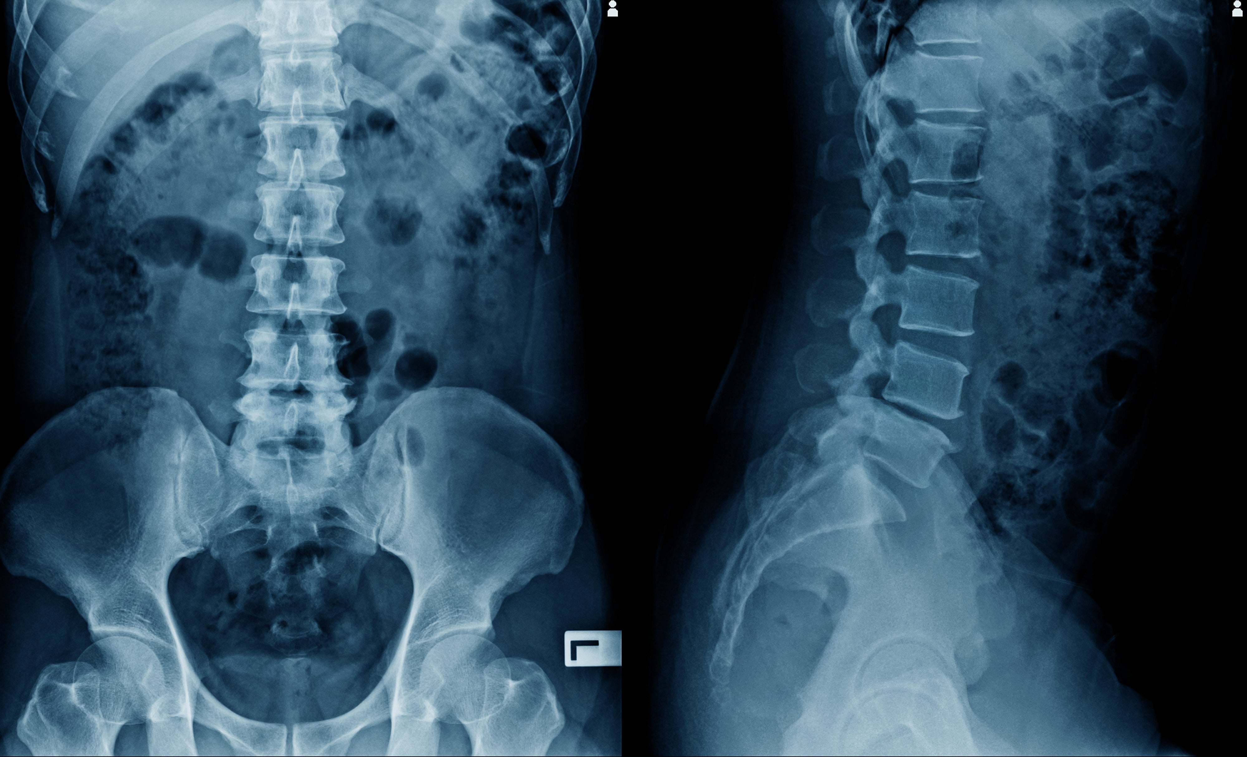X-ray images showing a frontal and lateral presumption of a quality spine and pelvis