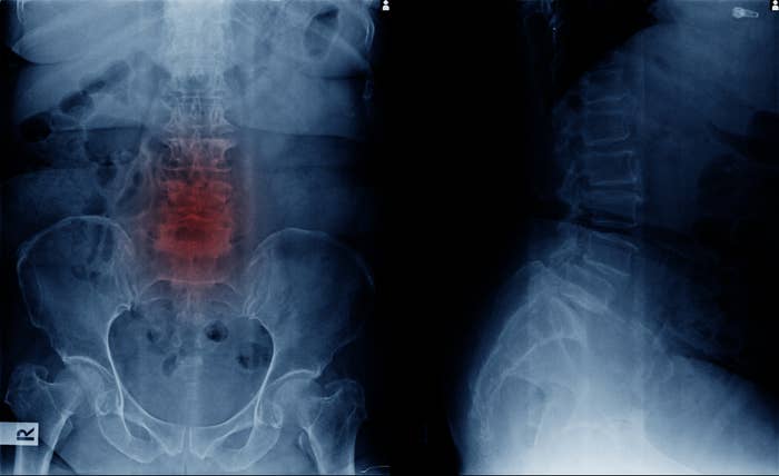 X-ray showing little   spine and pelvis with highlighted country  indicating imaginable   spinal issue