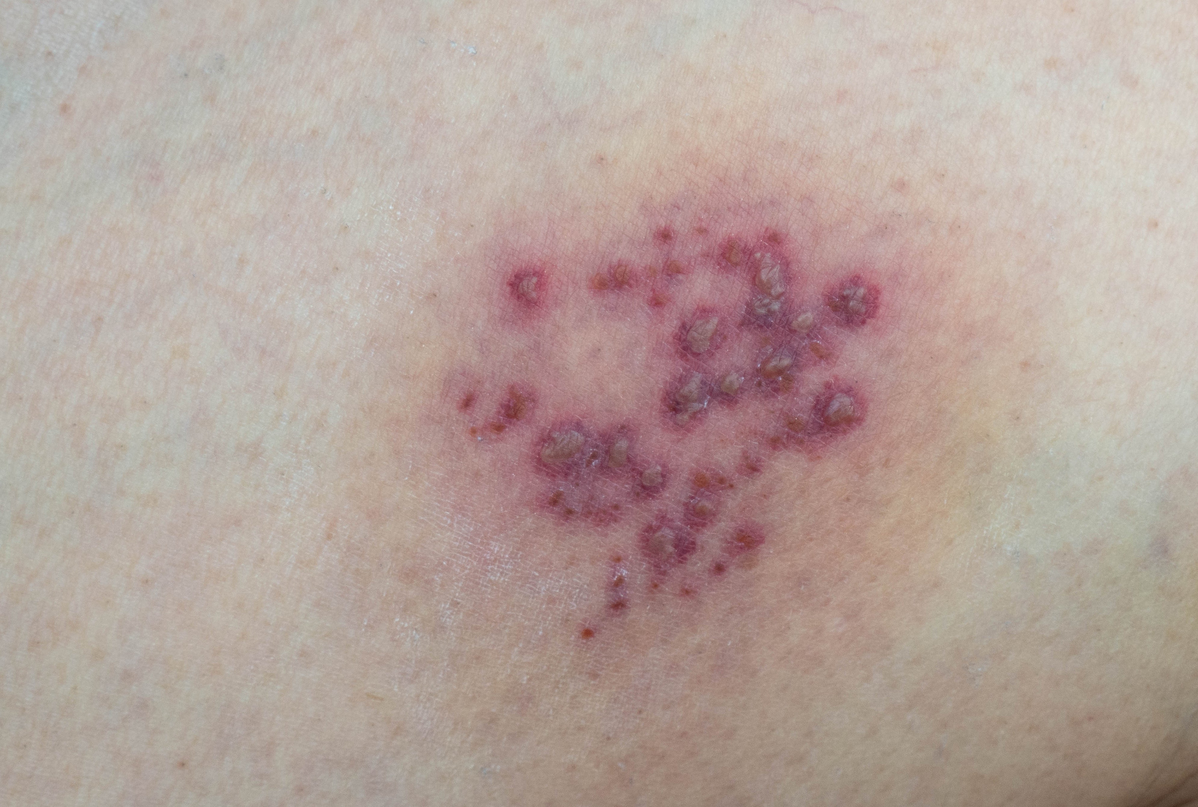 Close-up of tegument  with a clump   of red, raised bumps and irritation, suggesting a rash oregon  tegument  condition