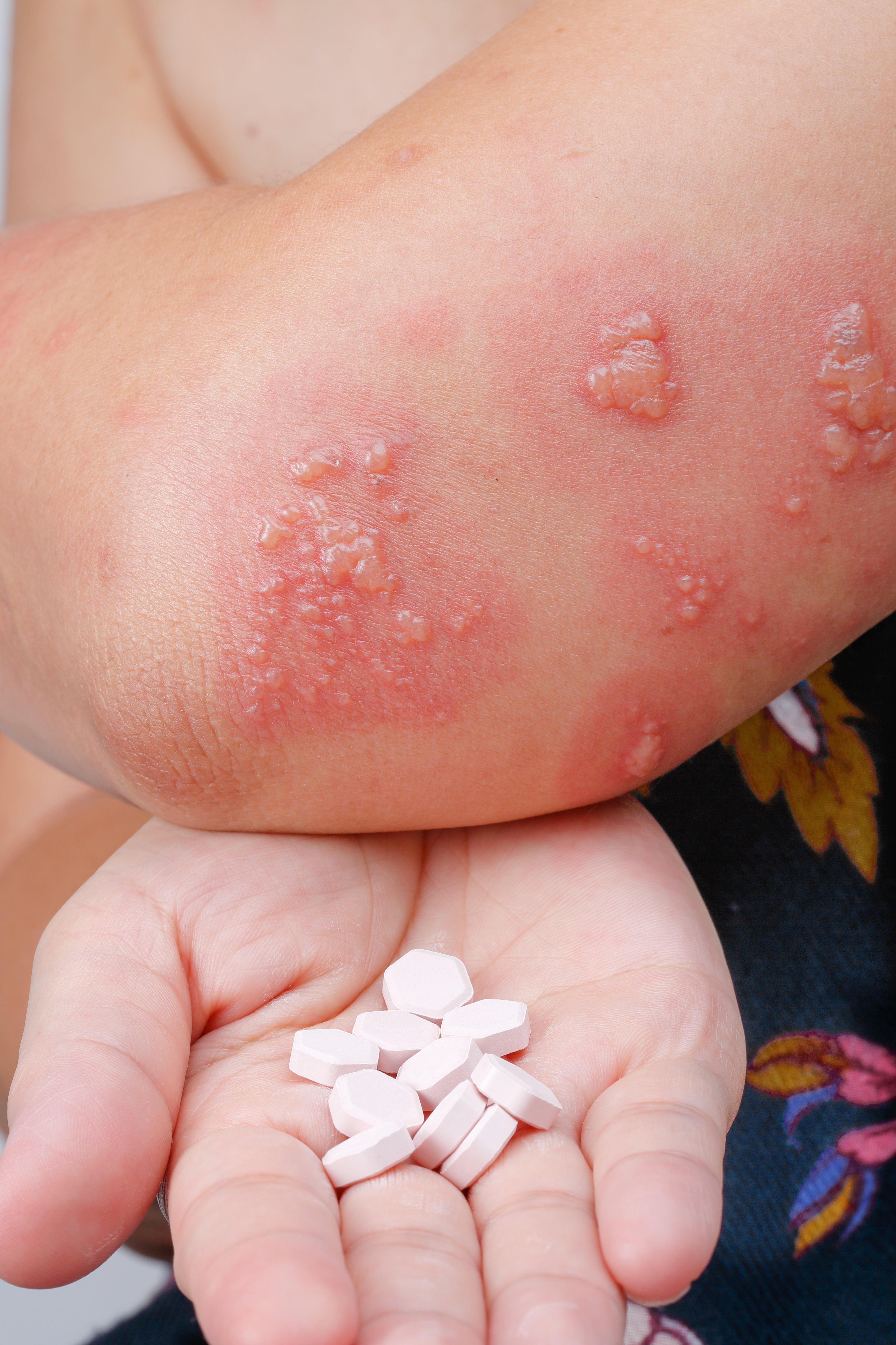 Close-up of an elbow with raised tegument  patches, apt  tegument  condition, and a manus  holding achromatic  pills, perchance  medicine  for treatment