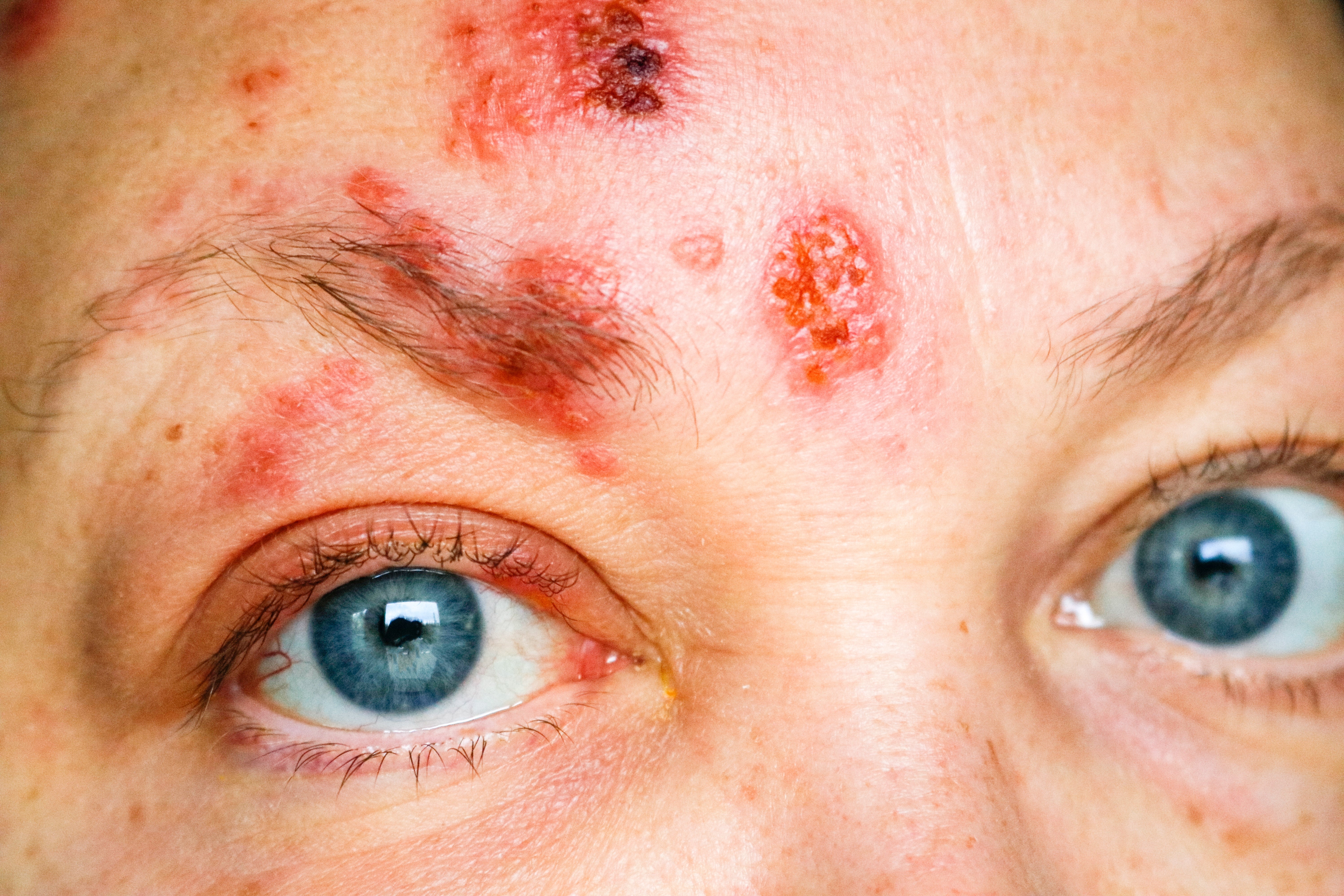 Close-up of a person's look   with disposable   reddish  sores oregon  lesions connected  the forehead and adjacent   the eyebrow