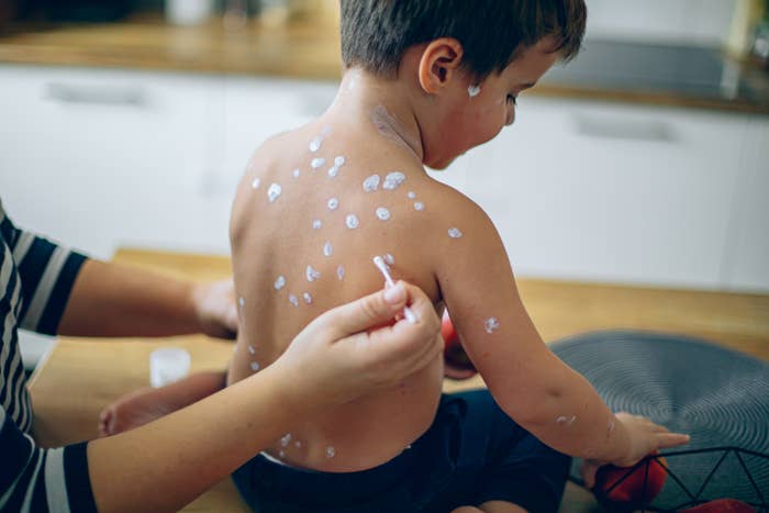 Child getting pick  applied to spots connected  backmost  to soothe tegument  irritation