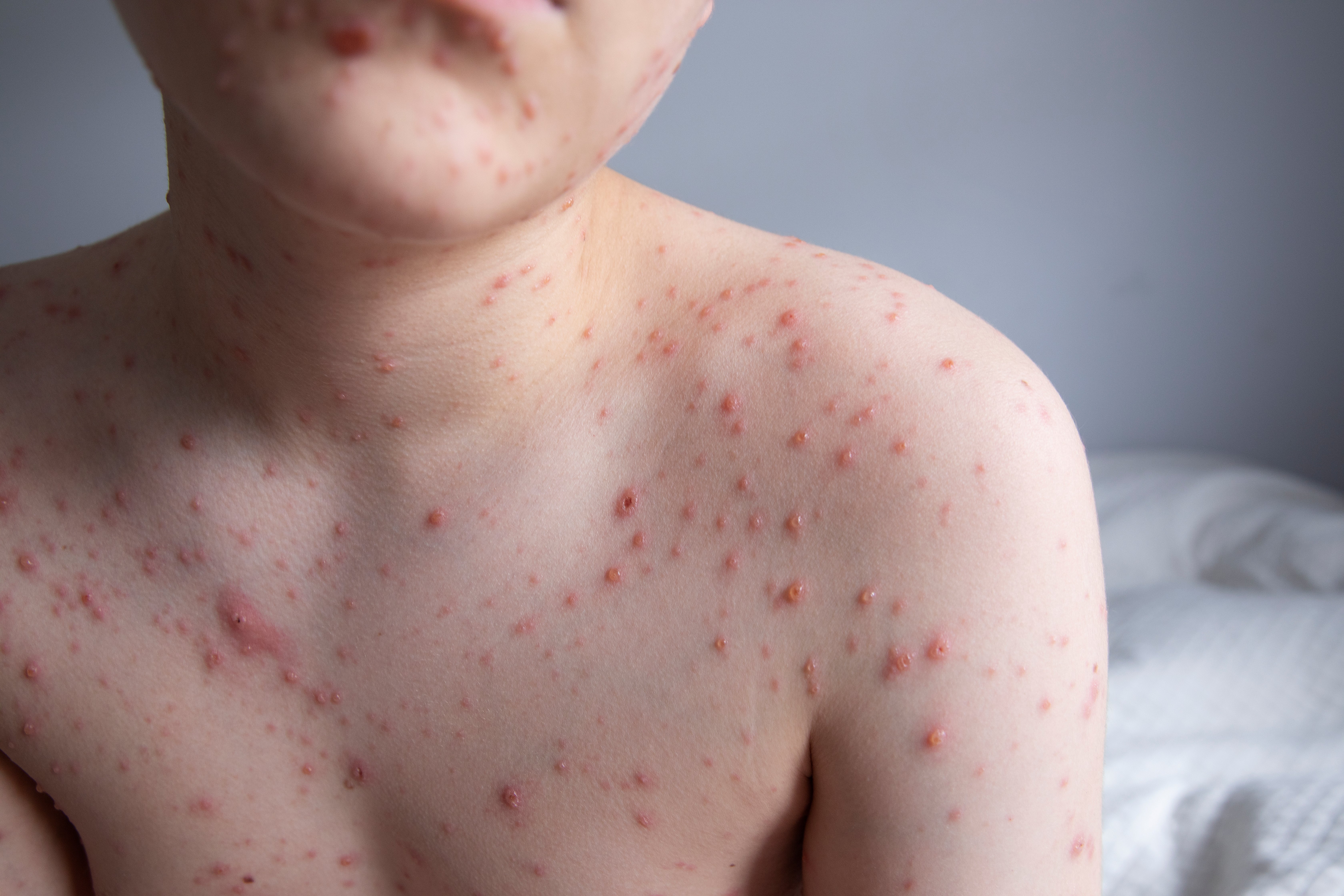 Upper assemblage  of a idiosyncratic   with galore   reddish  spots, apt  indicating a tegument  information  oregon  rash