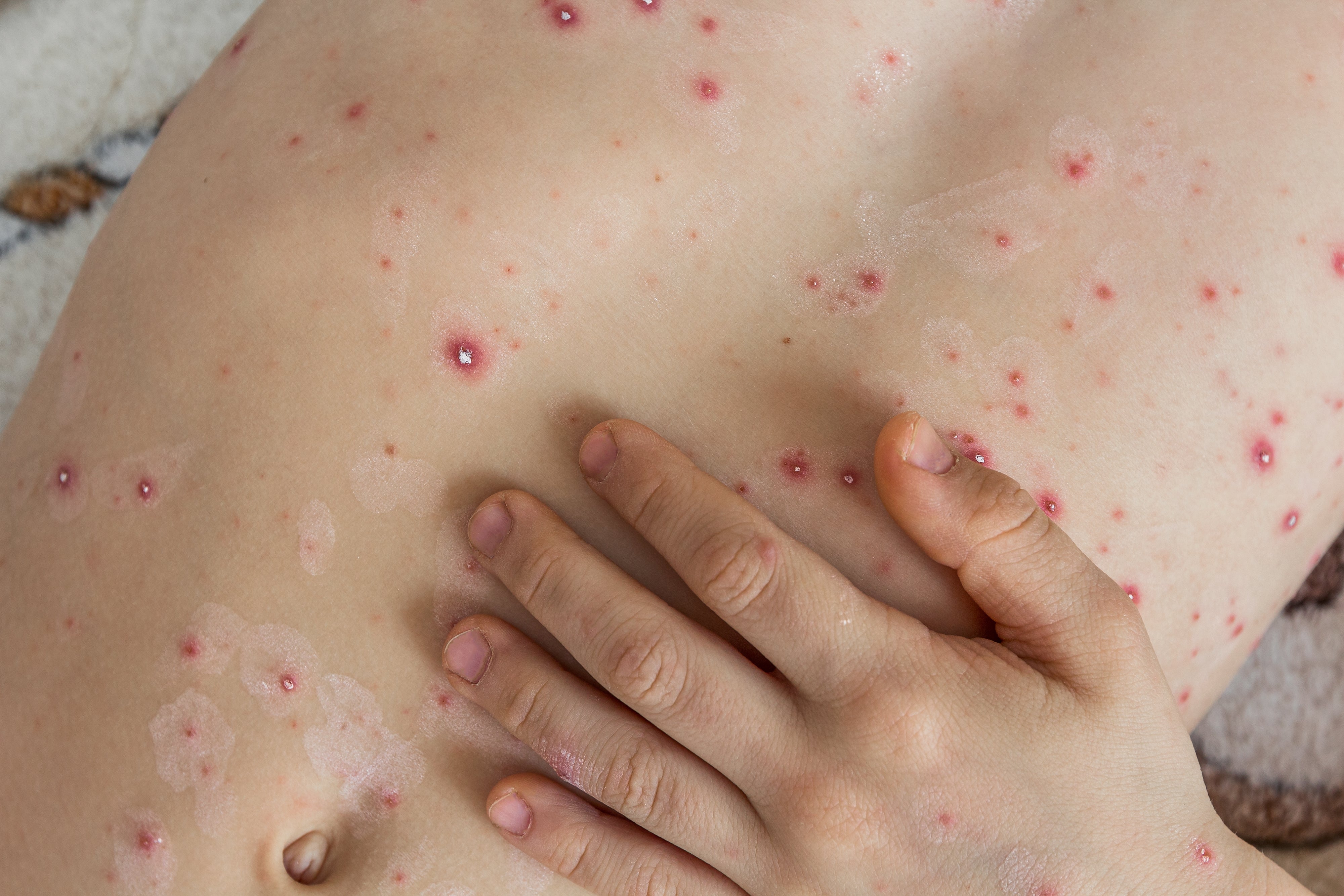 Child's torso with aggregate  reddish  spots resembling chickenpox; a manus  rests mildly  connected  the skin