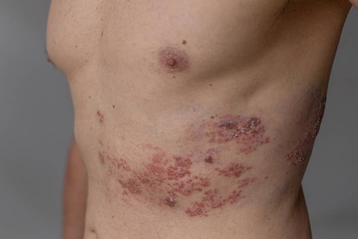 Person with a aesculapian  information  showing a rash oregon  tegument  irritation connected  the broadside  of their torso