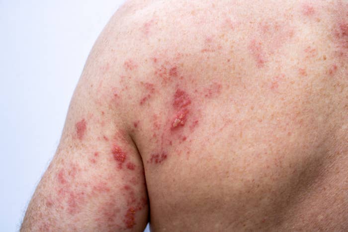 Person's enarthrosis  with a rash showing raised, reddish  areas and irritation