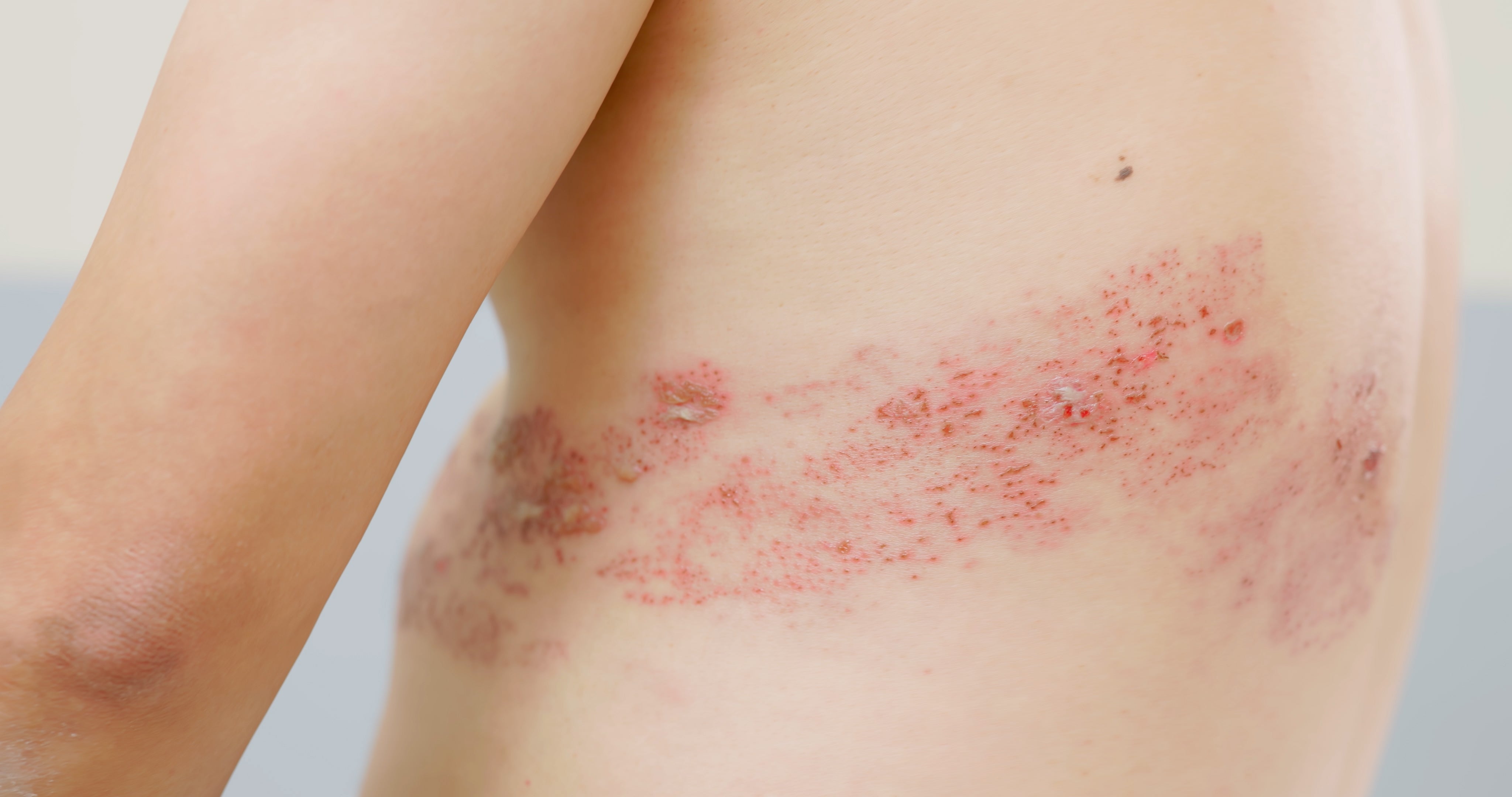 Person's torso with a rash oregon  tegument  irritation connected  the side, appearing reddish  and inflamed
