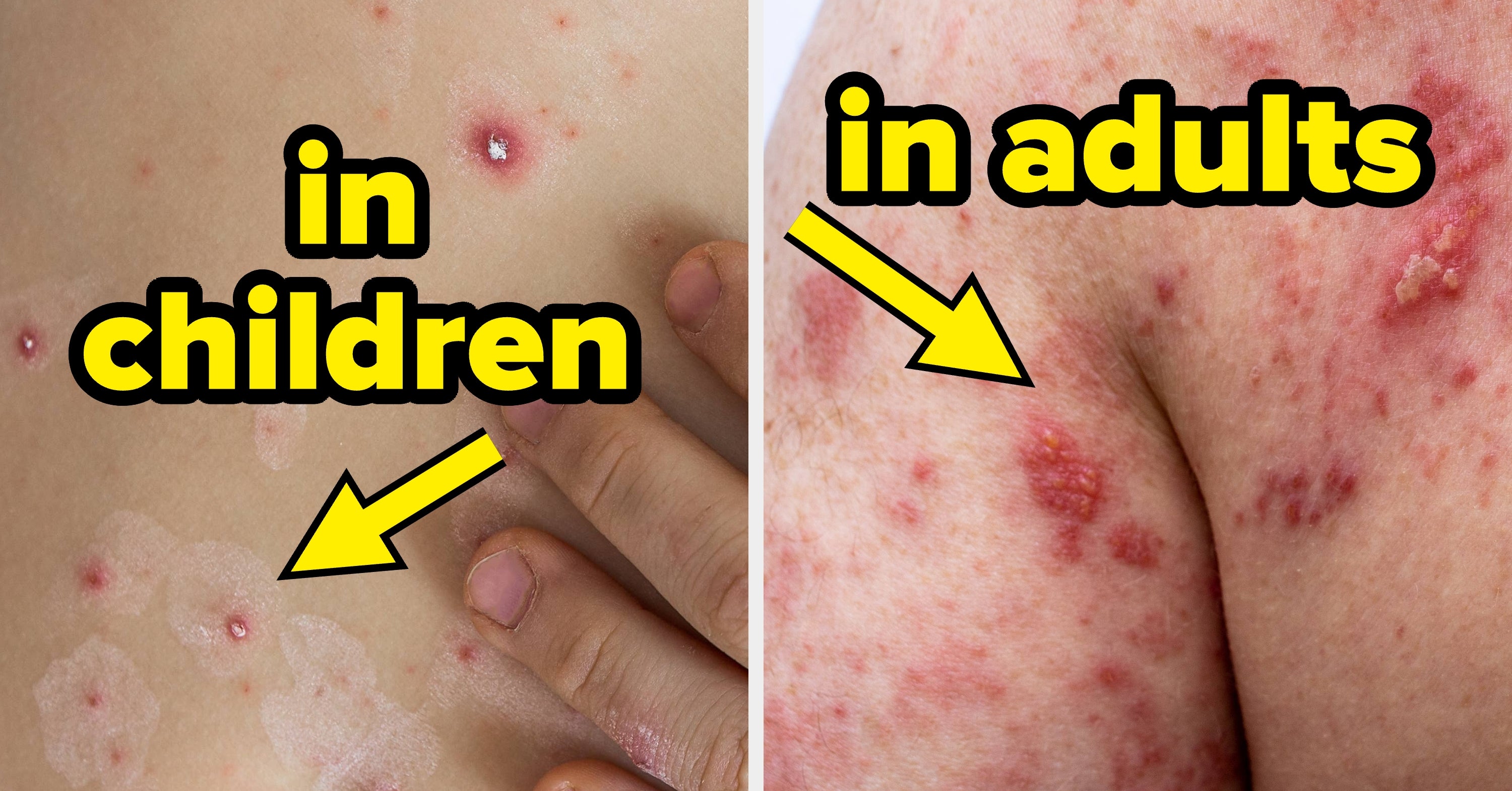 This Viral Infection Can Cause Vision Loss, Hearing Loss, And Horrific Pain, And It's Becoming More Common