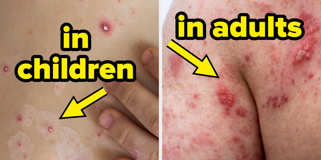 Doctors Are Explaining How To Avoid Shingles