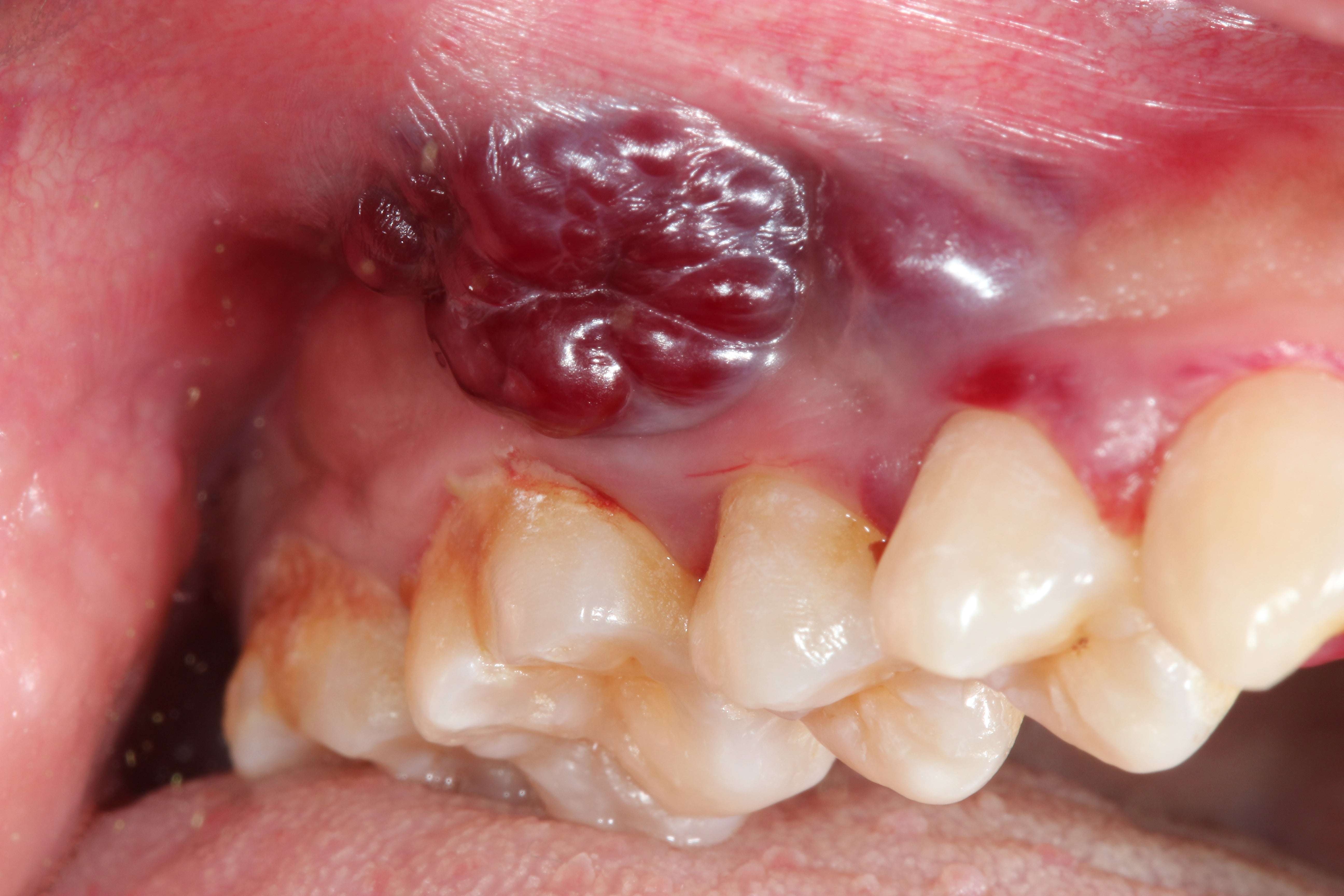 Close-up of an oral lesion wrong a mouth, adjacent to teeth