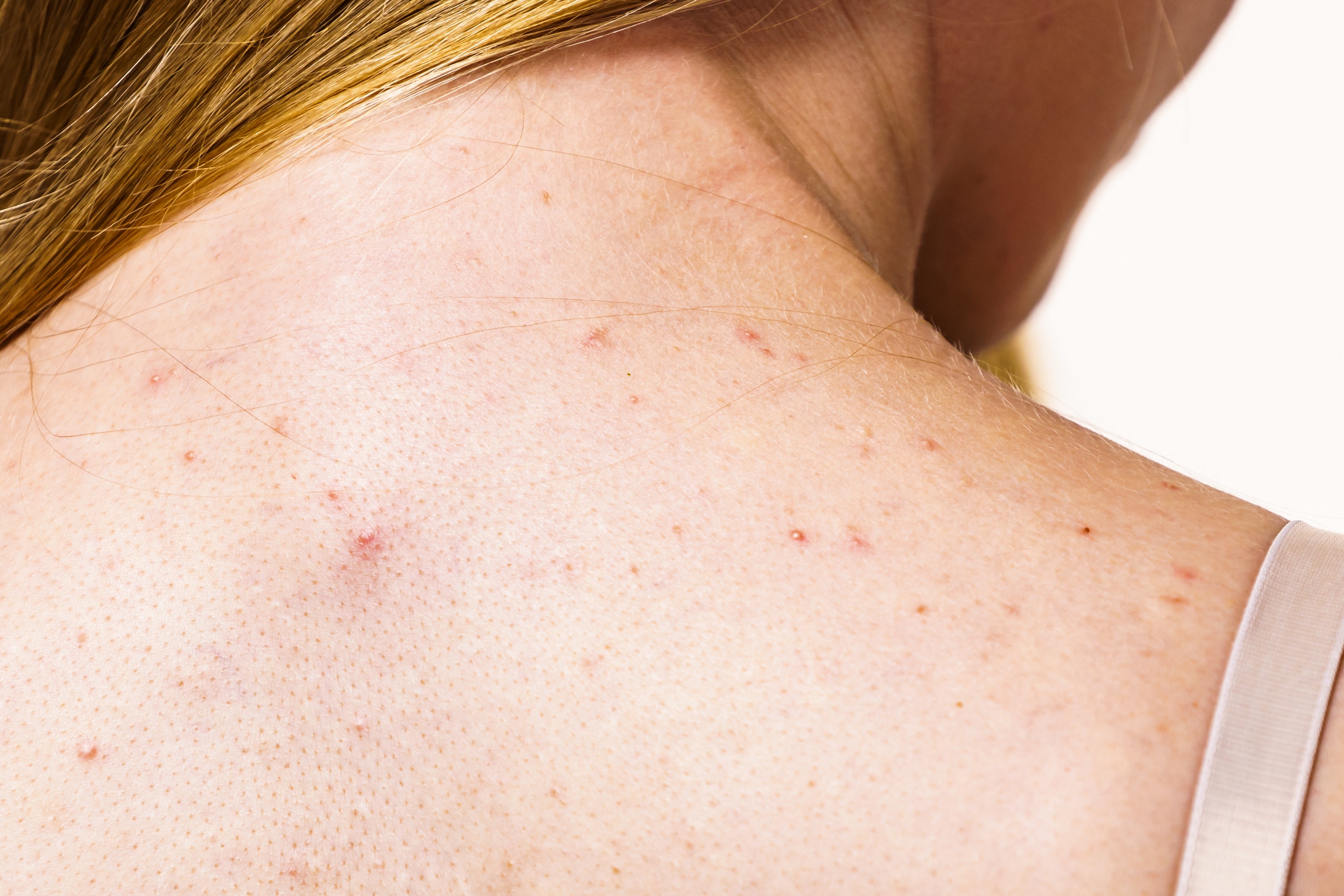 Close-up of a person's precocious backmost and enarthrosis with tiny tegument blemishes