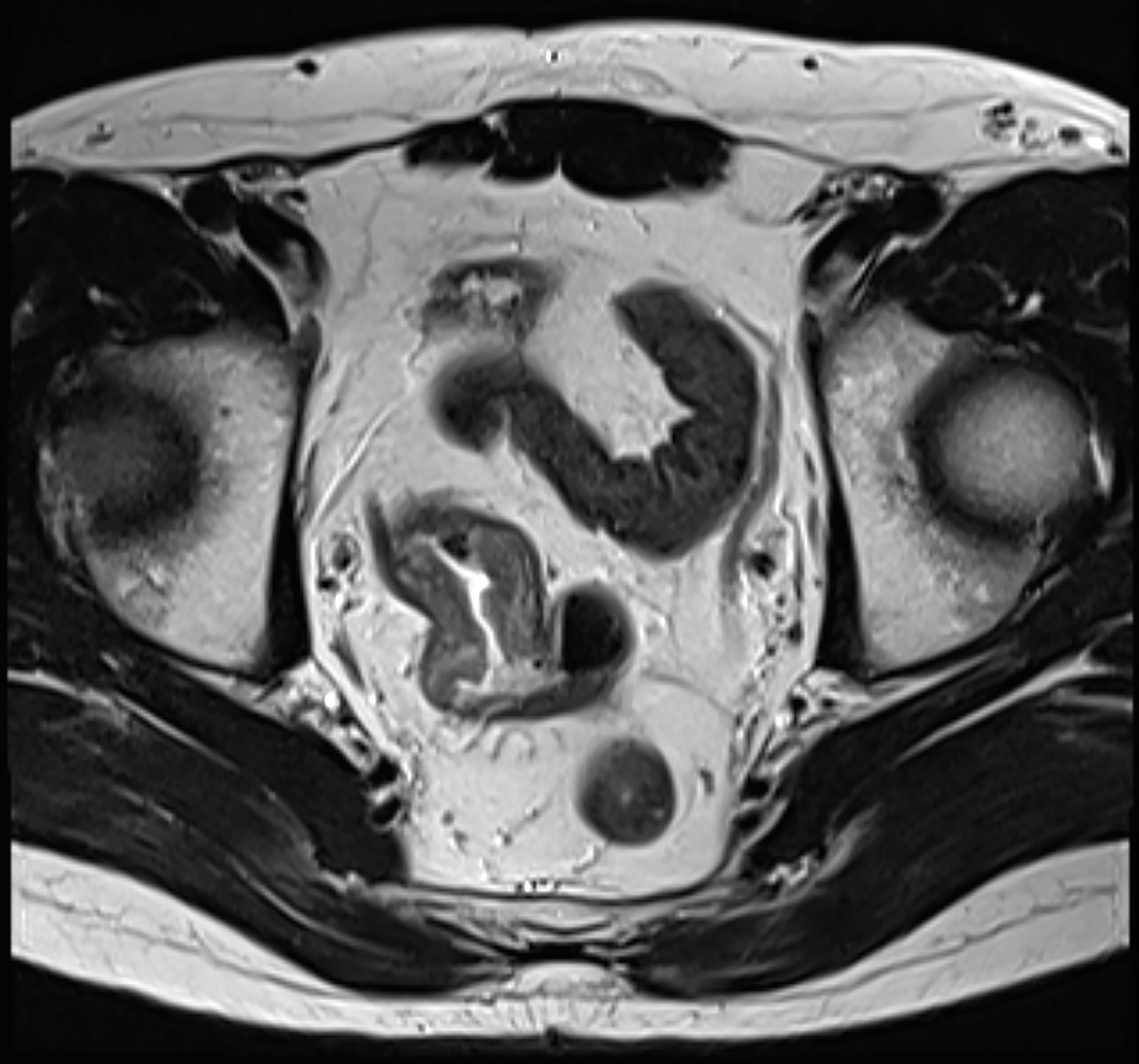 Medical MRI scan of abdominal region, showing interior   organs successful  detail. Used successful  health-related nonfiction  context