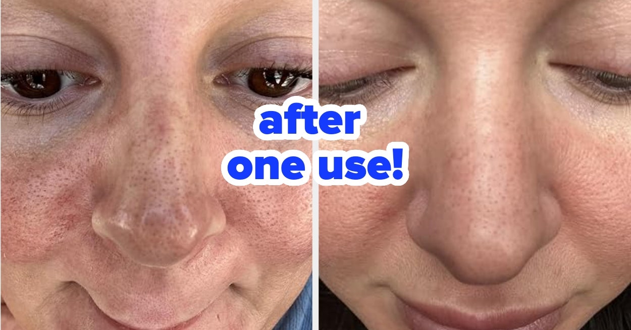 Stubborn Acne, Excess Oil, Redness: 31 Products To Help Banish Skin-Related Troubles