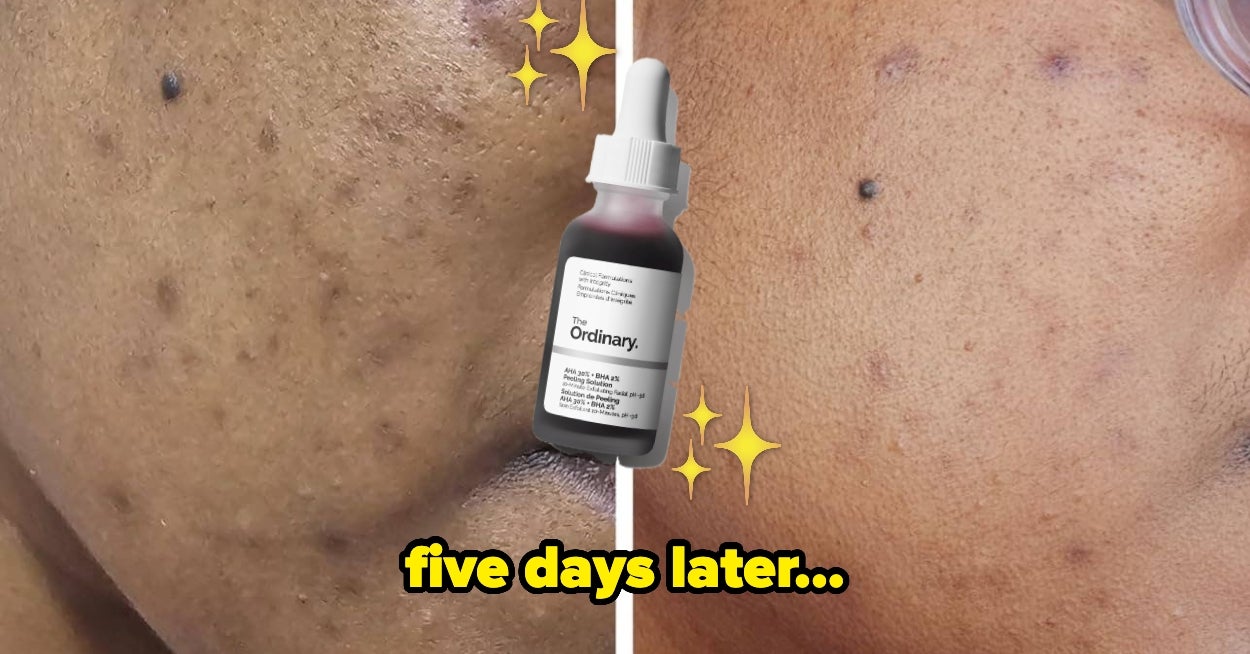 27 Acne Products That Are So Good, You’ll Want To Cry Happy Tears