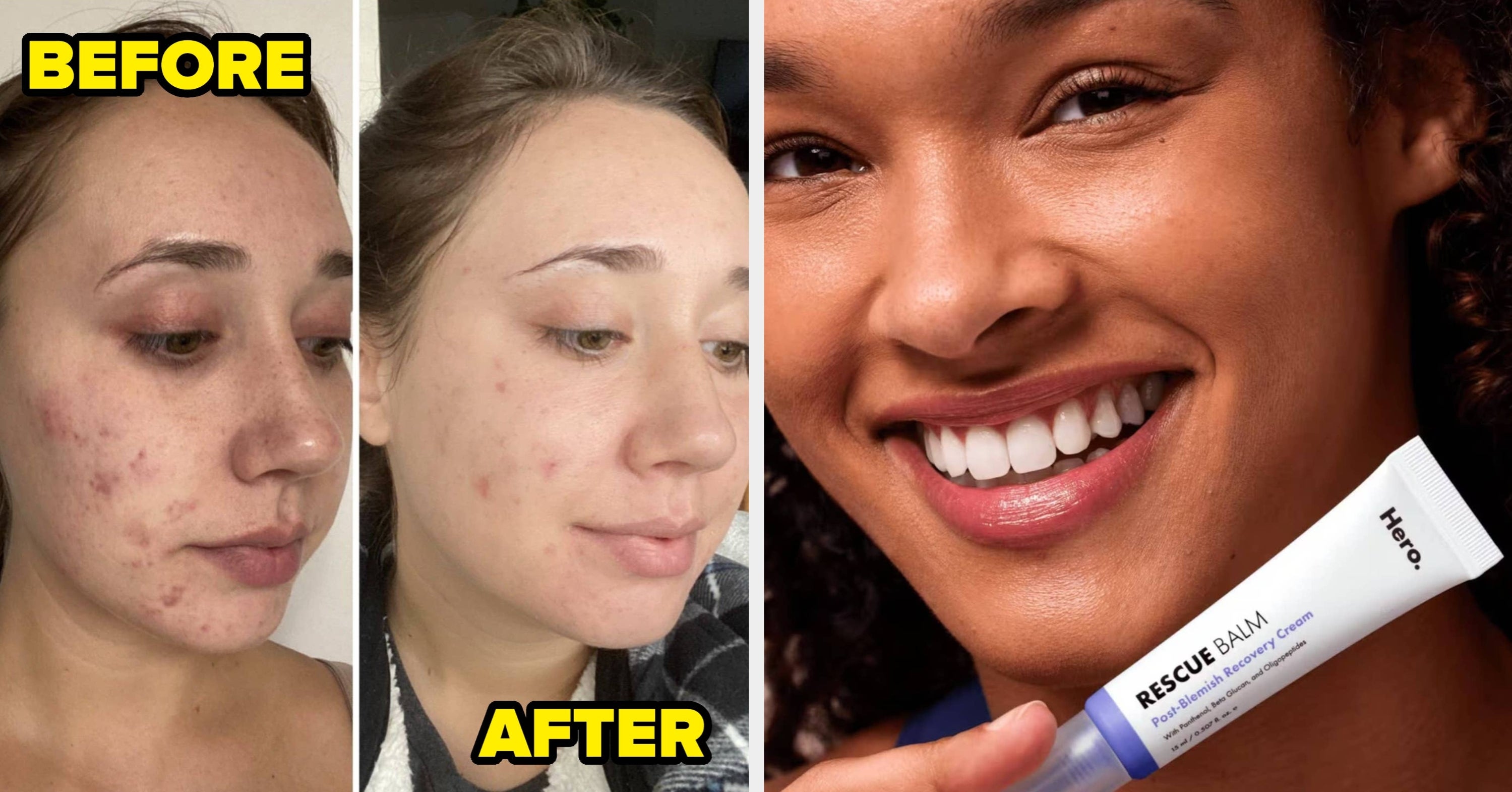 27 Acne Solutions So Good At Their Jobs They Deserve To Be “Employee Of The Year”