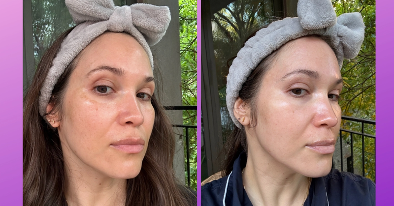 Here's Everything That's Worked To Reduce My Hyperpigmentation And Melasma