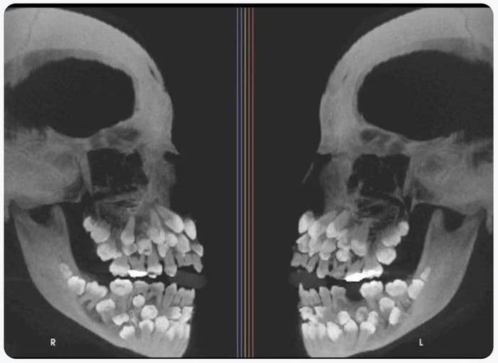 X-ray of 2  skull profiles showing teeth alignment from the broadside  view