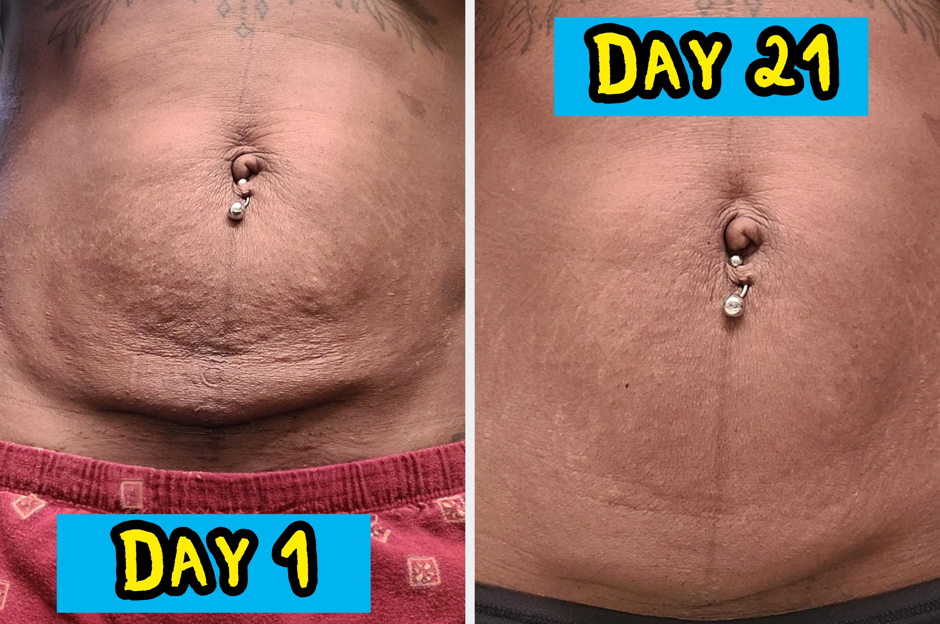 Close-up of a belly button with visible skin changes over 21 days, showing improvement in texture. Text reads "Day 1" and "Day 21"