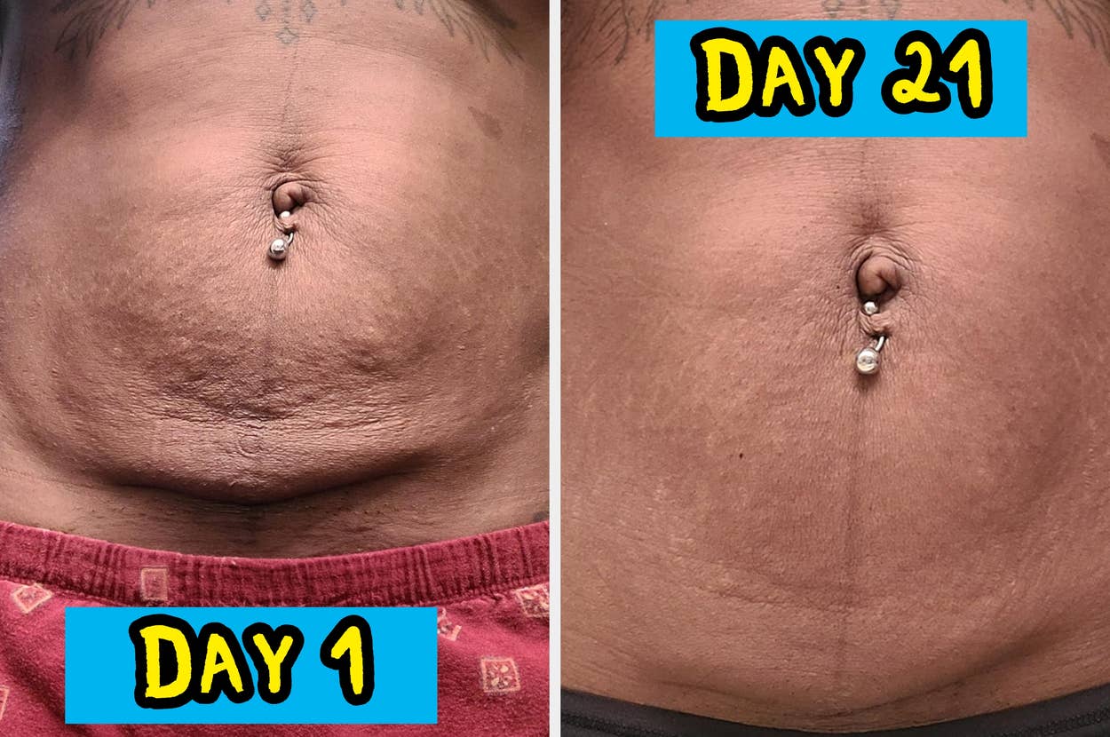 Close-up of a belly button with visible skin changes over 21 days, showing improvement in texture. Text reads "Day 1" and "Day 21"