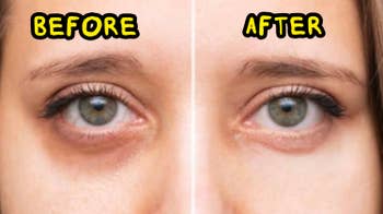 Close-up of a woman's eyes showing a examination of under-eye areas earlier and aft utilizing an oculus cream