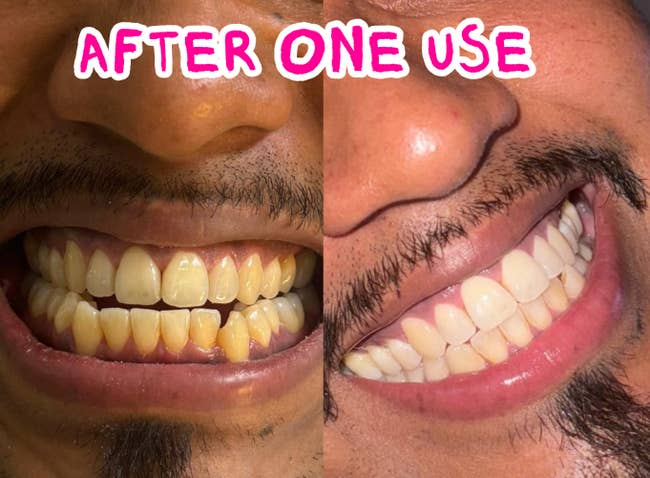 Before and aft images showing teeth whitening results. The near broadside displays yellowed teeth, portion the close broadside shows visibly whiter teeth