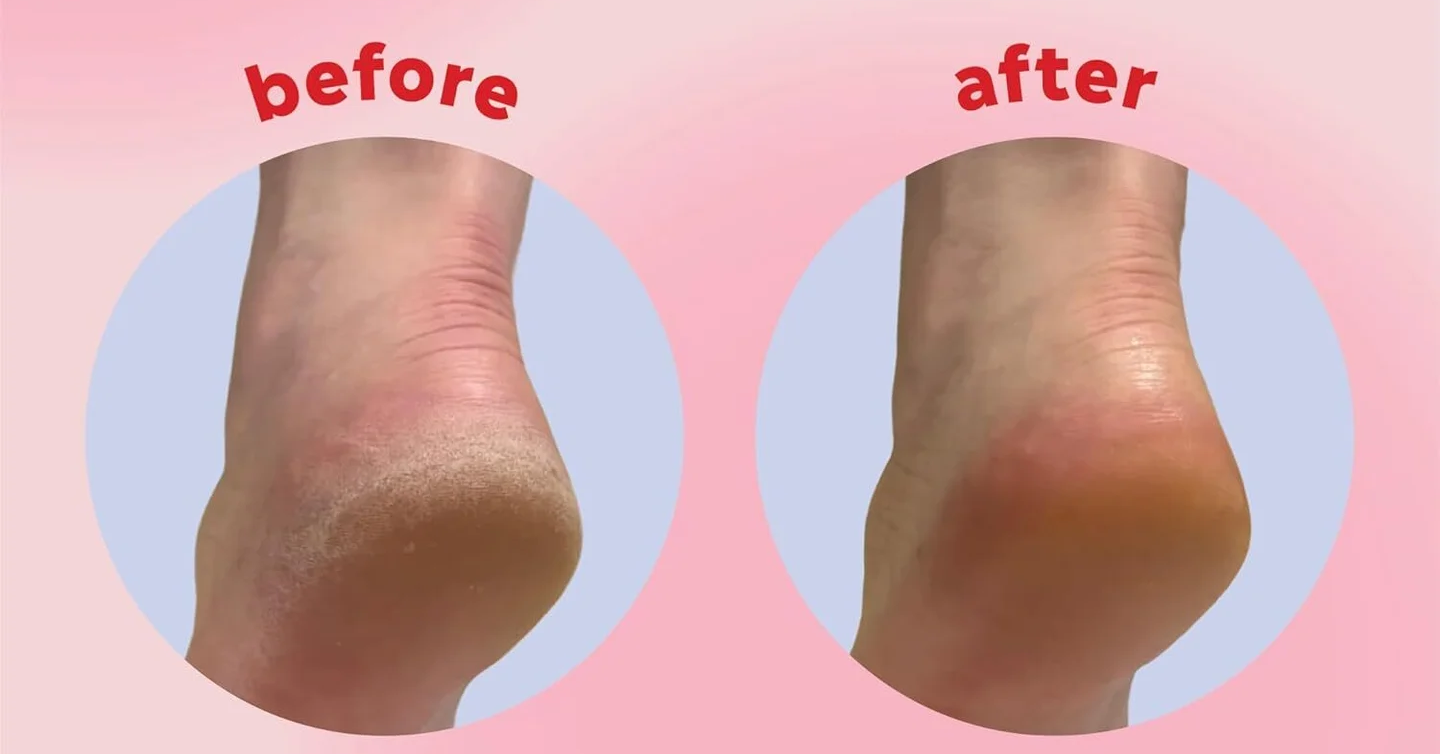 My Heels Were Painfully Cracked Until I Found This Mess-Free Balm