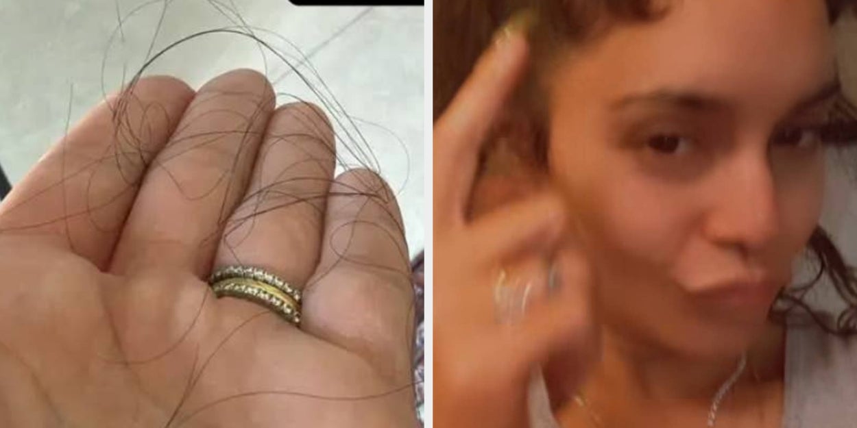 Vanessa Hudgens Postpartum Hair Loss, Regrowth Update