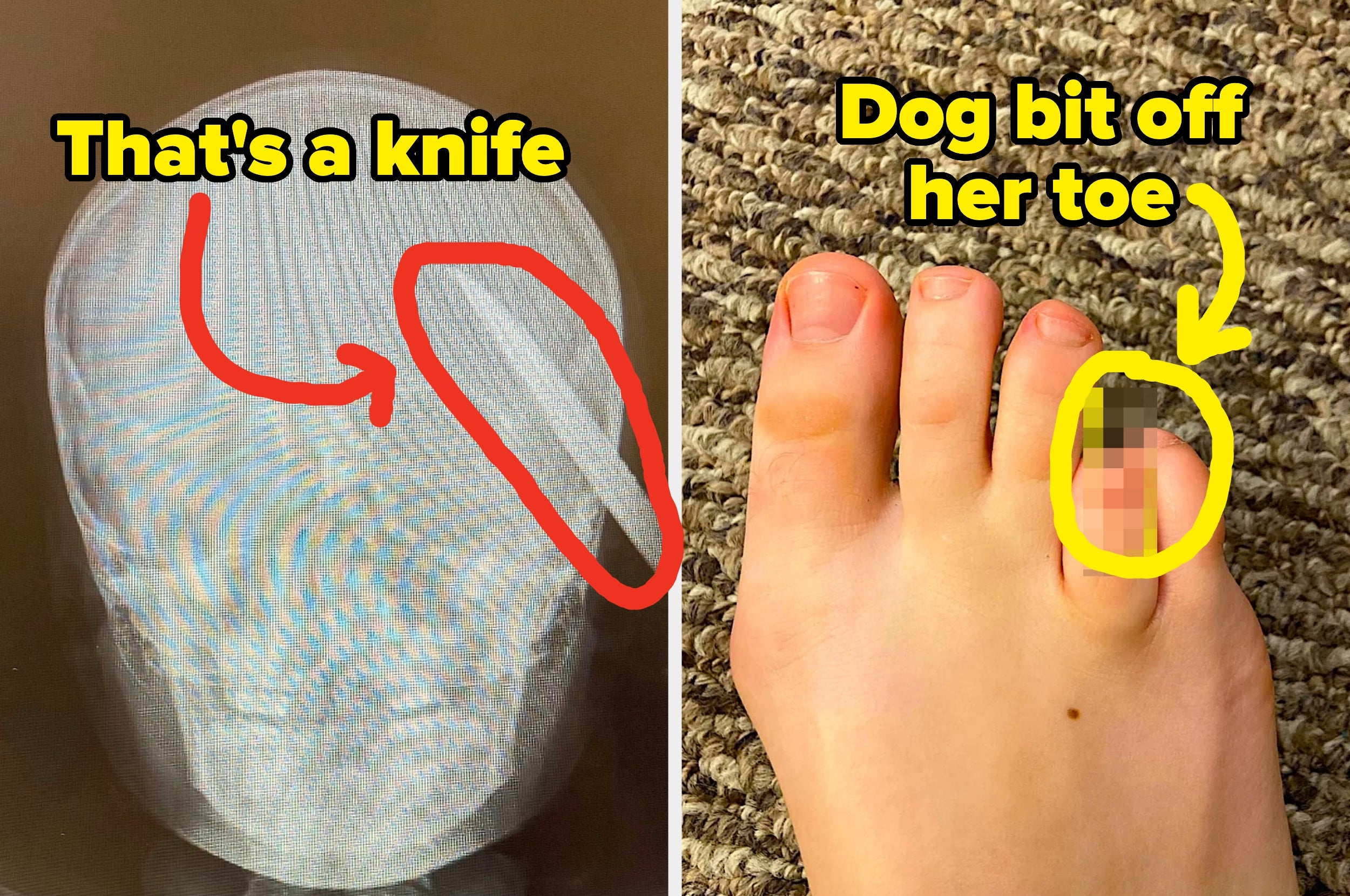 X-ray image shows a knife in a head; toe with missing part due to a dog bite