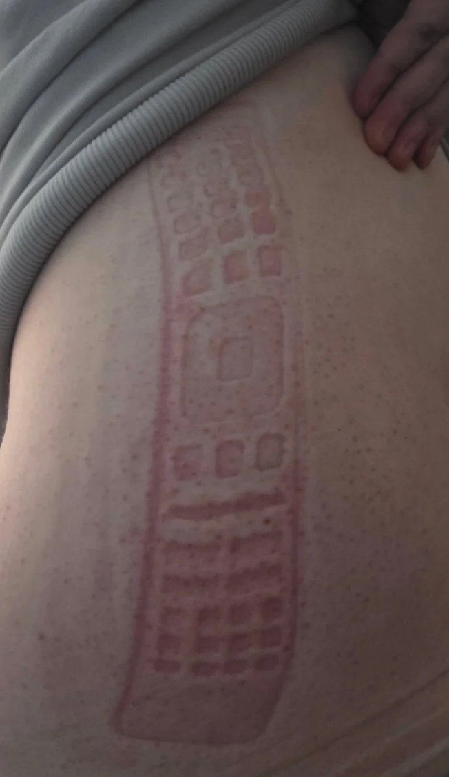 Remote control imprint on a person's skin