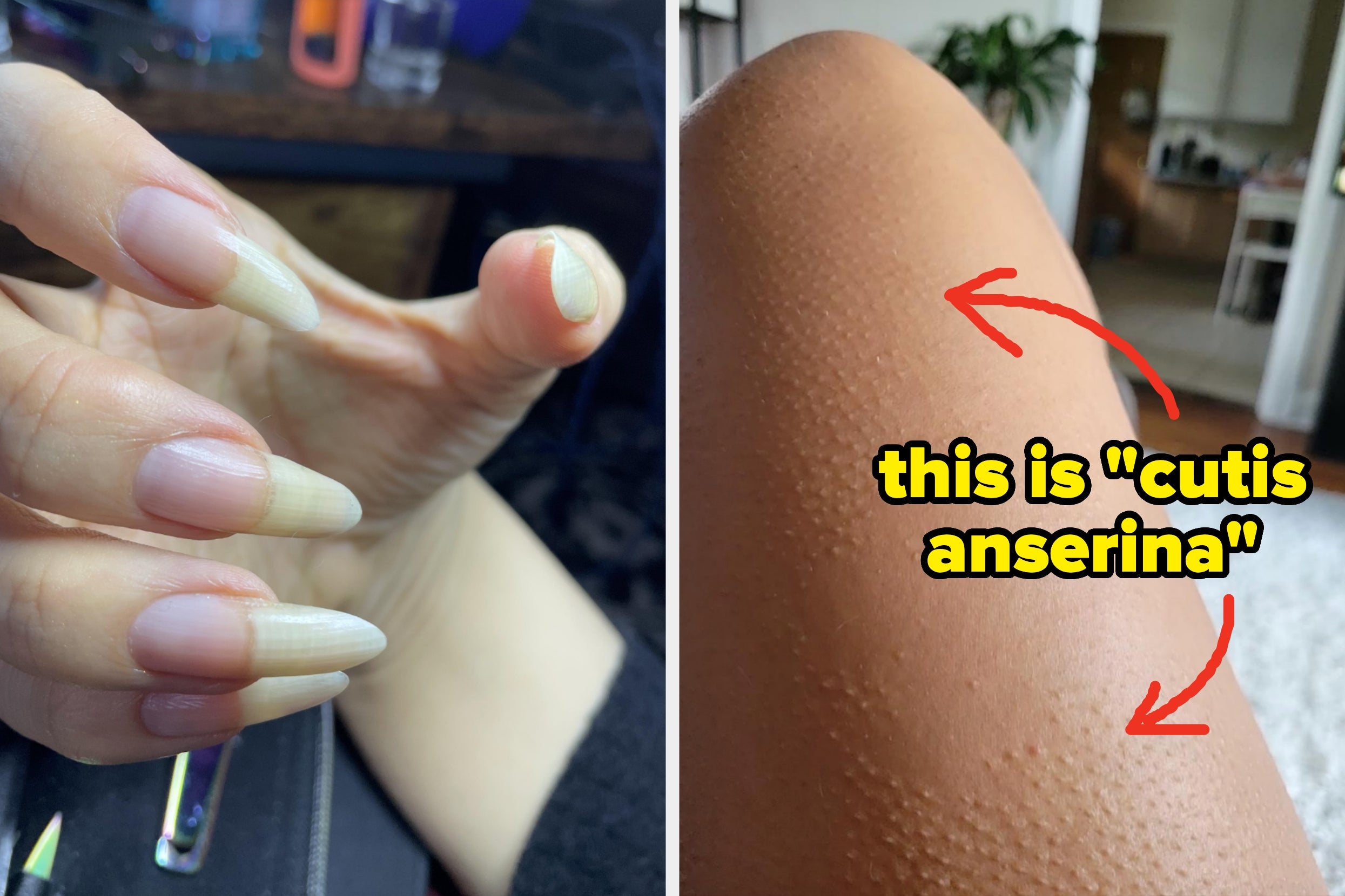 Close-up of long fingernails on one hand and leg with goosebumps, labeled "cutis anserina"