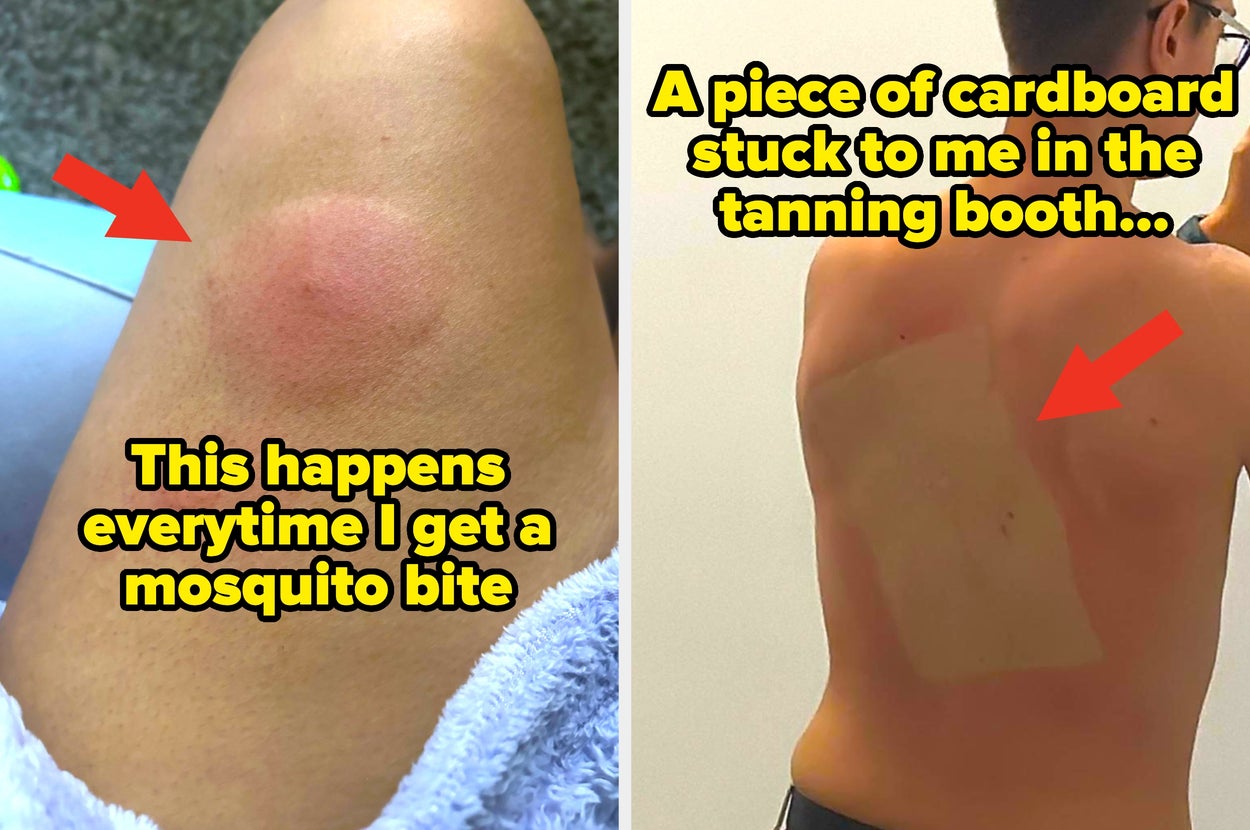 Left: Large swollen mosquito bite on leg. Right: Sunburned back with cardboard outline from tanning booth mishap