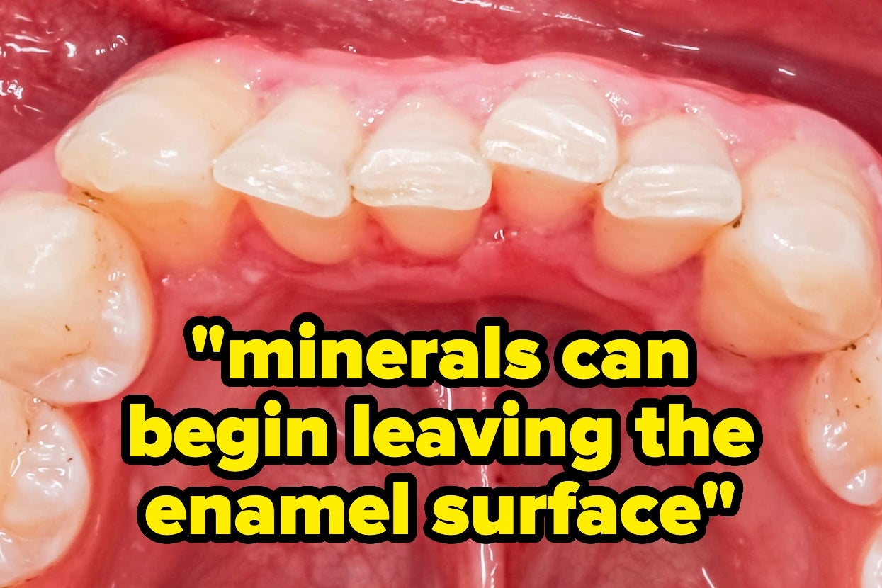 Close-up of teeth illustration with text: "Minerals can begin leaving the enamel surface."