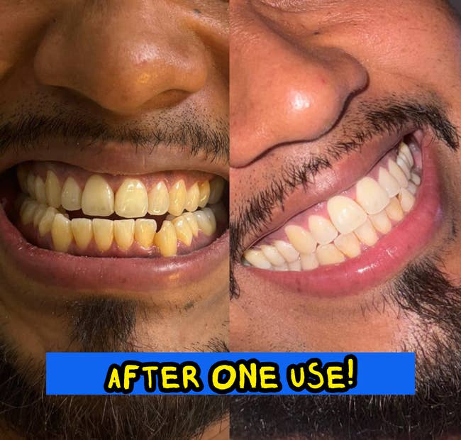 Before and aft images showing teeth whitening results. The near broadside displays yellowed teeth, portion the close broadside shows visibly whiter teeth