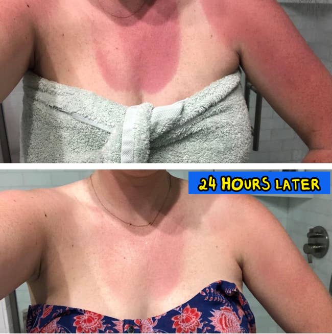 Two images amusement a idiosyncratic with sunburnt shoulders and precocious chest, archetypal successful a towel, past successful a strapless top, highlighting severity and signifier of the burn