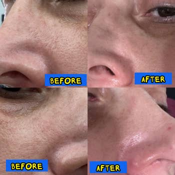 Close-up images amusement tegument texture and pores connected a person's face, dated 11/19 and 11/26, highlighting changes implicit time