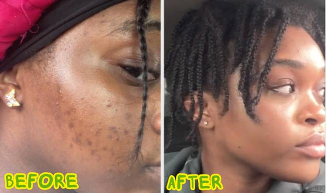 Before and aft photos of a reviewer, showing important betterment successful tegument clarity and texture. The