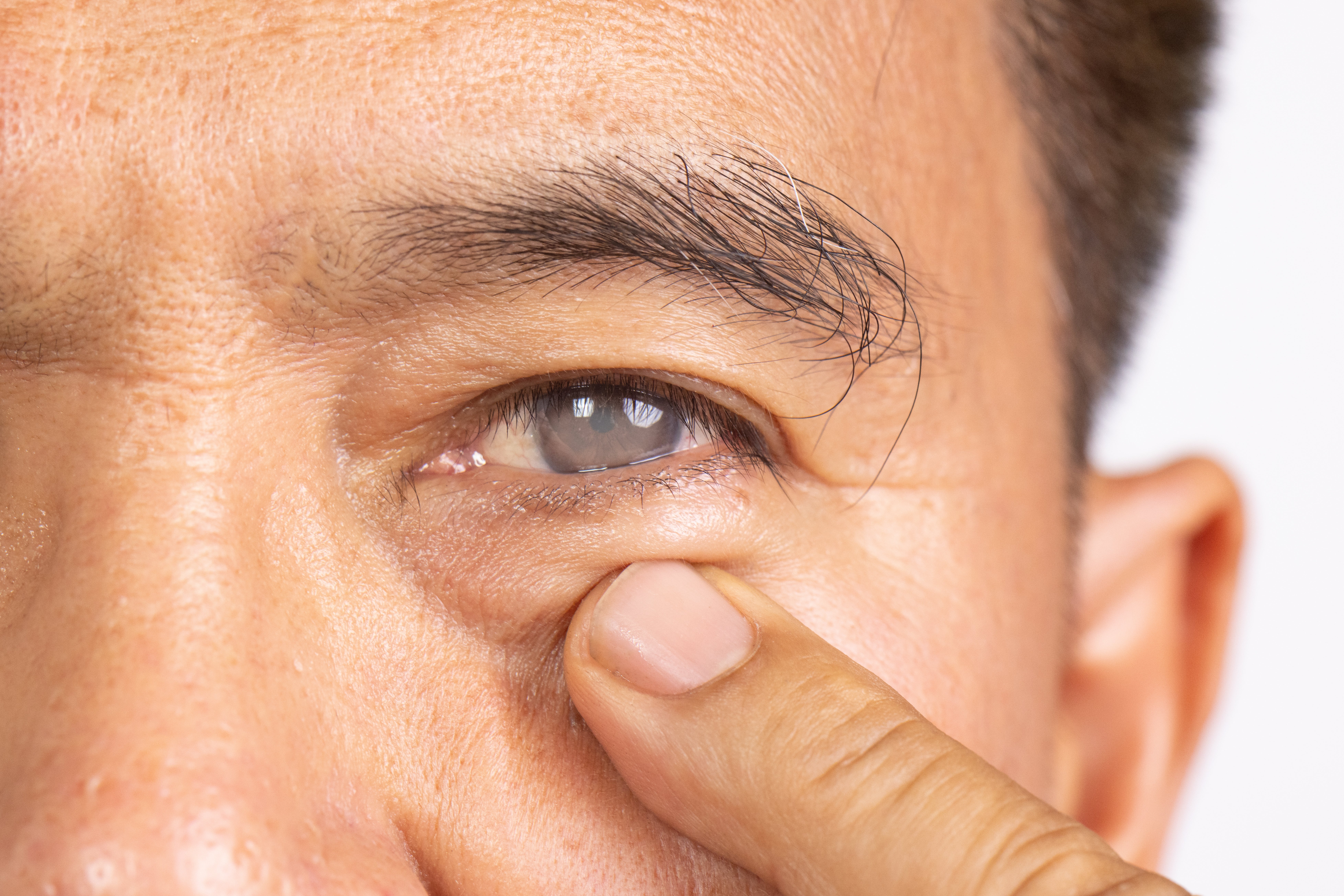 Person holding lower eyelid, revealing a visible cataract on their eye