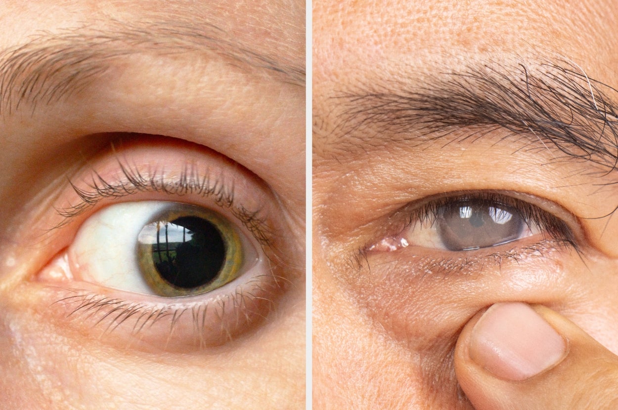 Close-up of two eyes: one with a normal pupil, the other with signs of cataract, illustrating a health condition