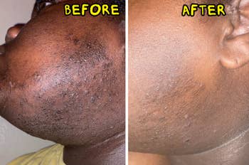 the reviewer earlier and aft utilizing the toner pads to cleanable up ingrown hairsbreadth bumps