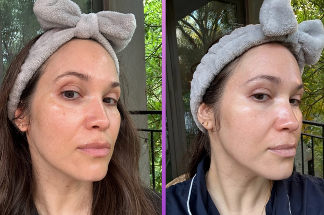 Here's Everything That's Worked To Reduce My Hyperpigmentation And Melasma