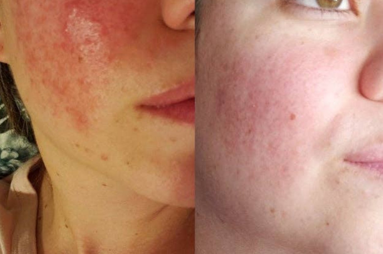 Close-up of a person's cheek showing a skincare transformation, from red and inflamed to smoother skin