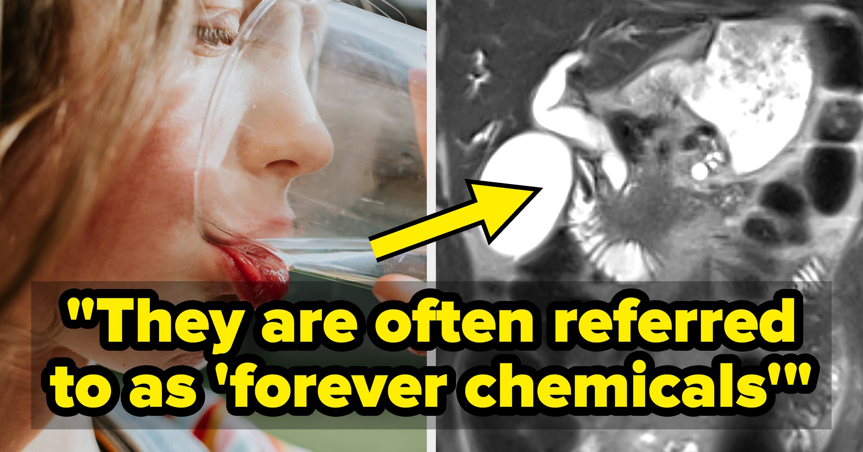 Doctors Are Warning That Sparkling Water Could Increase Your Risk Of Colorectal Cancer
