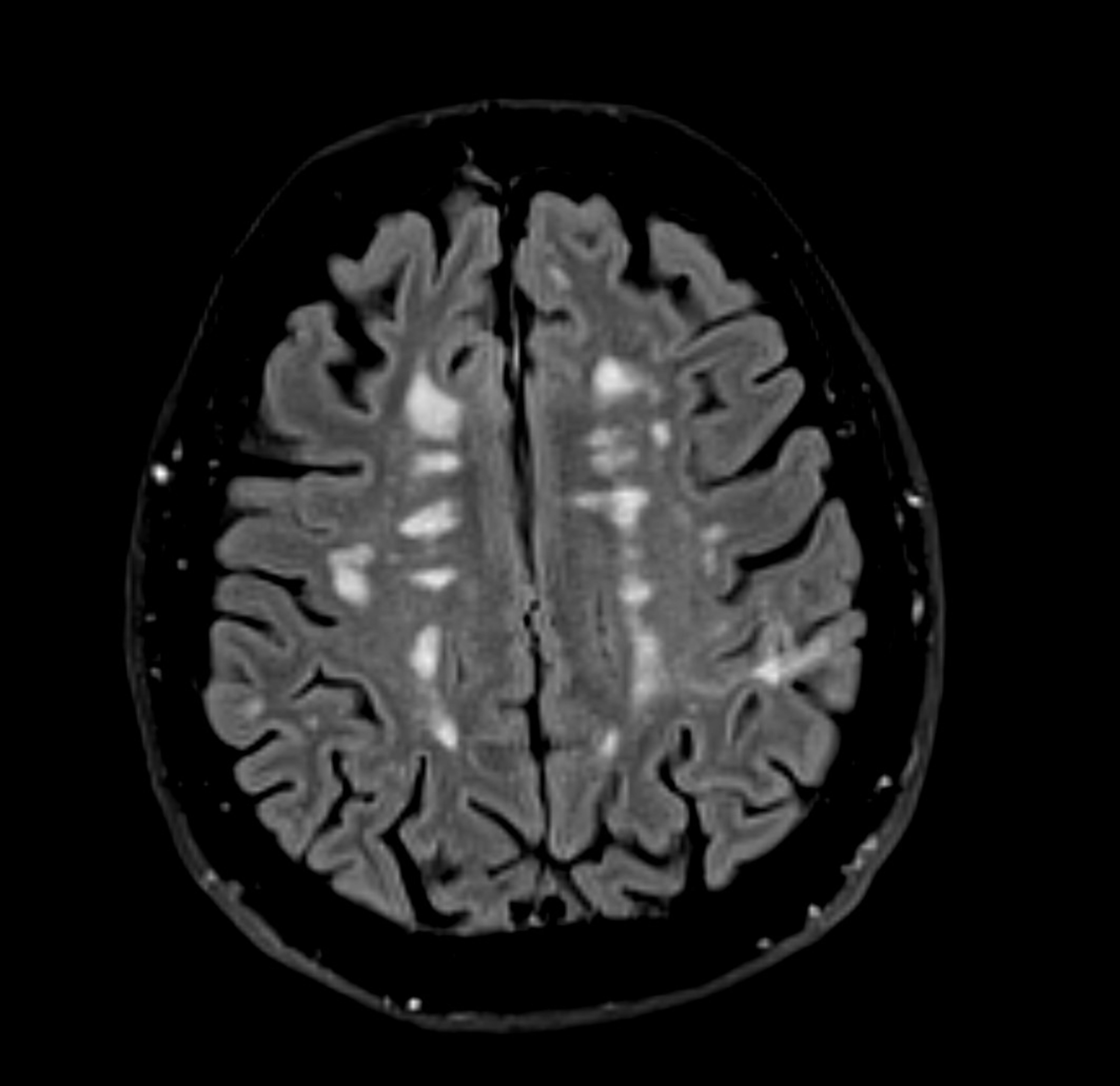 MRI scan of a human brain showing detailed sections of brain tissue and structures