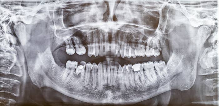 Tooth 18 Radiograph 9 Things Dentists Would Never, Ever Do To Their Teeth