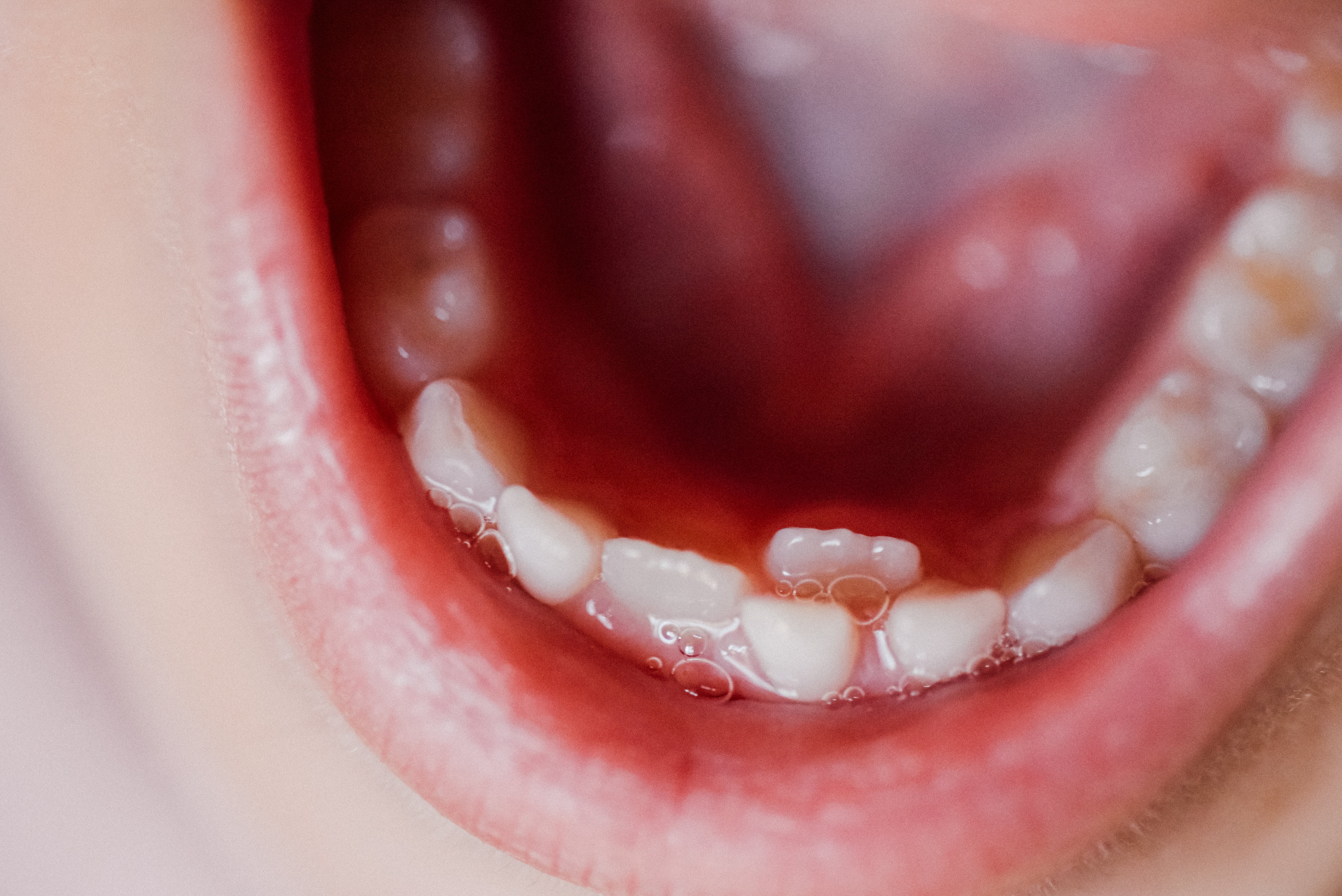 Close-up of a child's mouth showing rows of new teeth growing behind baby teeth