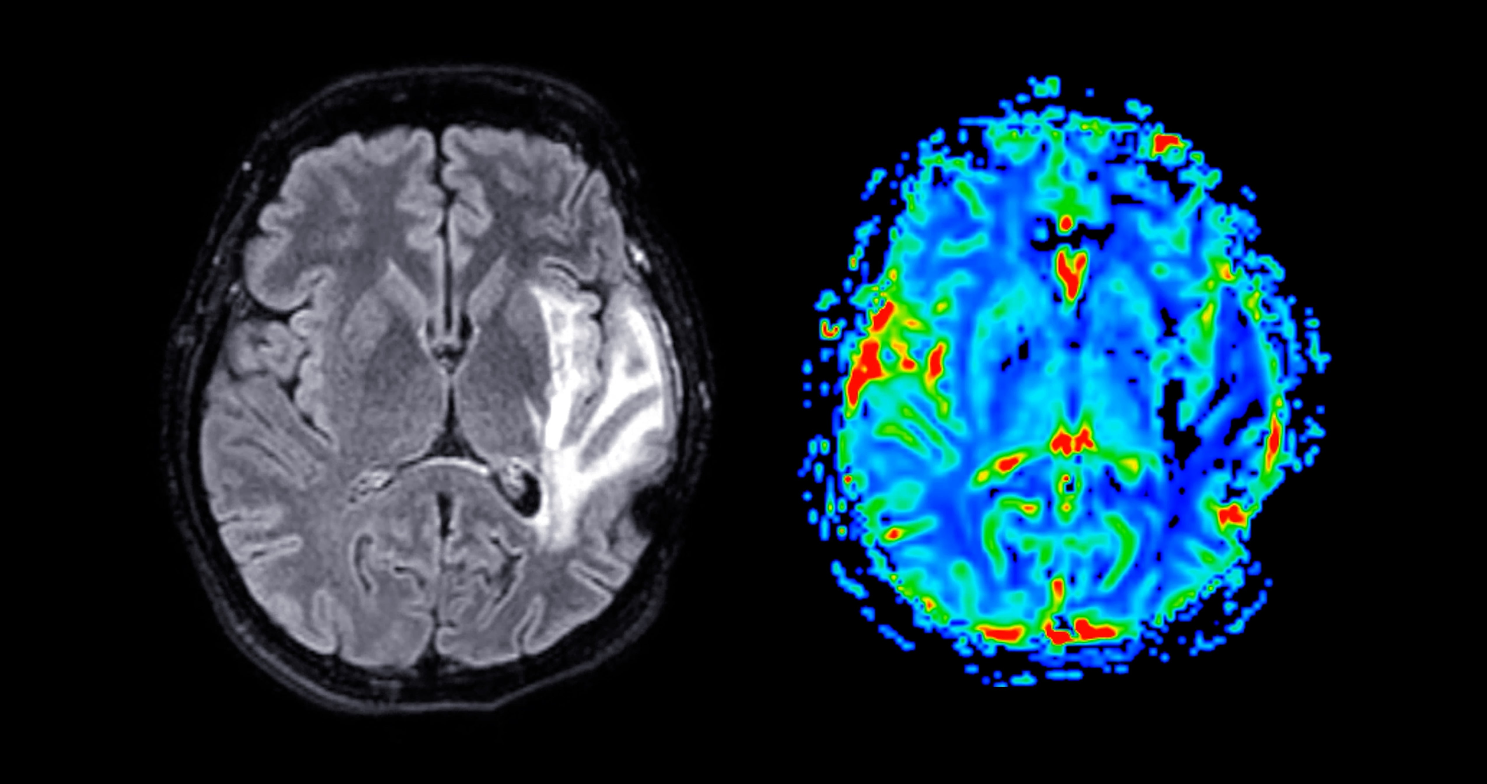 MRI brain scan on left; colorful brain activity map on right, showing varying intensities