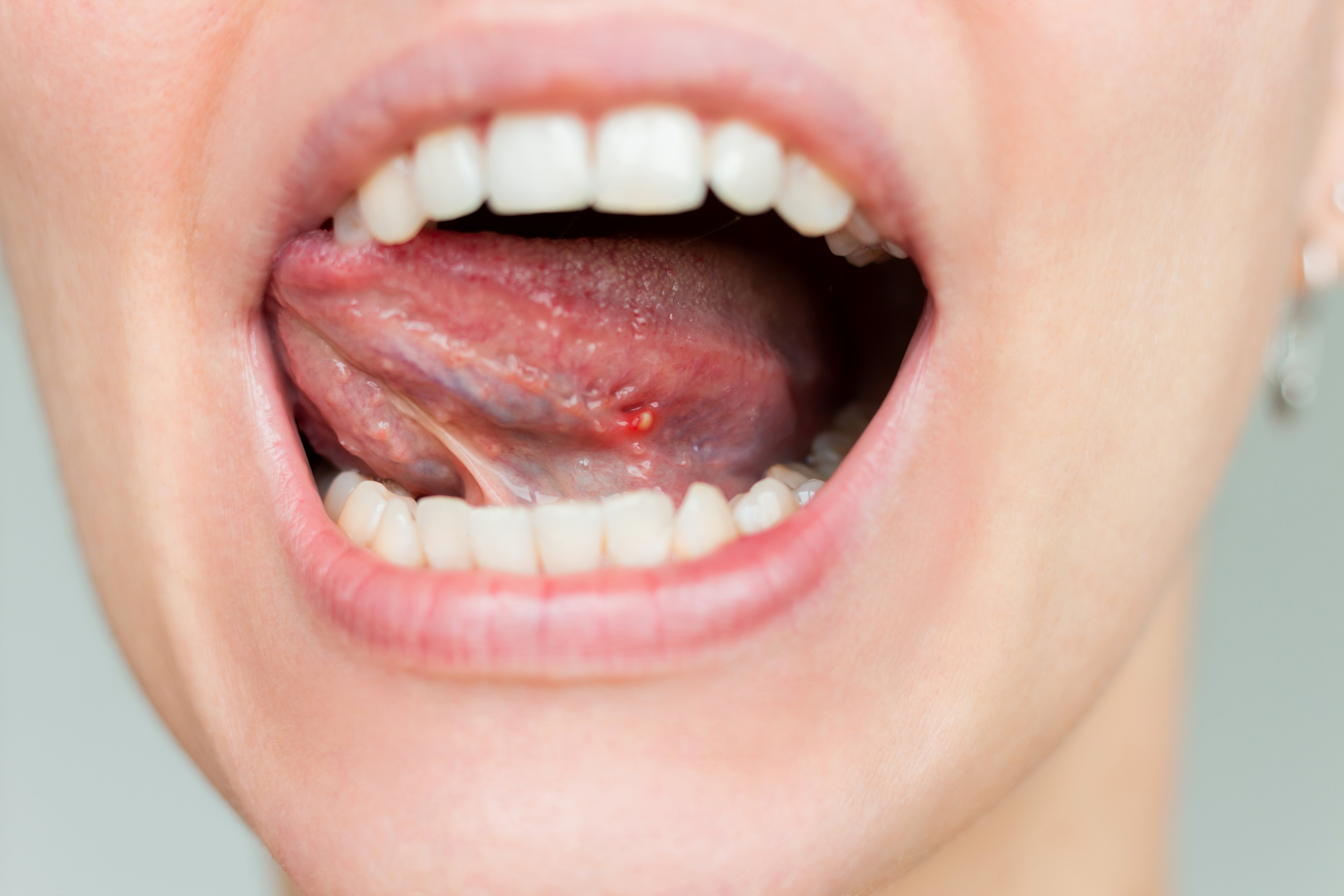 Mouth open wide showing a tongue with a small inflamed sore