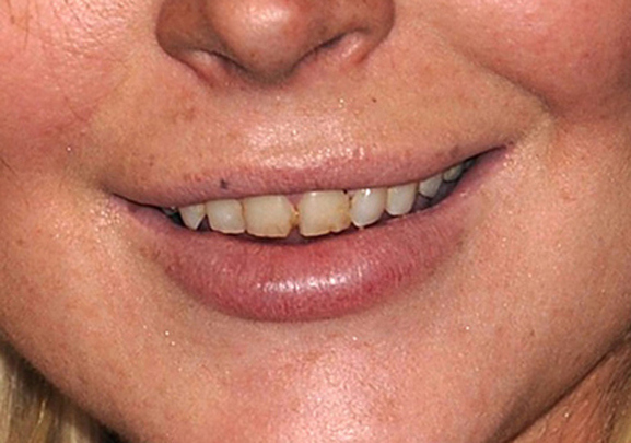 Lindsay Lohan&#39;s Teeth