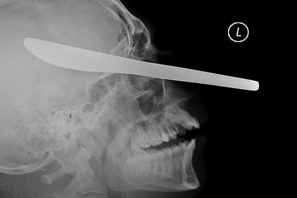A butter knife lodged in the eye of a patient.